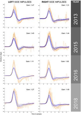 Enhanced Vestibulo-Ocular Reflex Responses on vHIT. Is It a Casual Finding or a Sign of Vestibular Dysfunction?